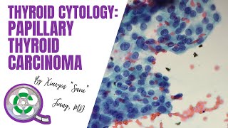 Thyroid Cytology Papillary Thyroid Carcinoma [upl. by Erina]