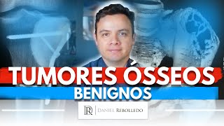 Tumores Ósseos Benignos Tipos mais comuns na infância tratamento e cirurgias [upl. by Honor]