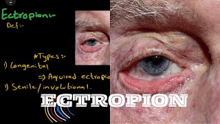 What is ectropion  And it’s types  causes  symptoms  grades and treatment [upl. by Norward158]