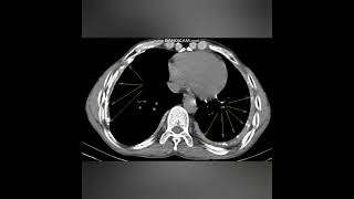 TUBERCULOUS EMPYEMACHRONIC  XRAY AND CT IMAGEA new case every daySame time tomorrow [upl. by Alakim]