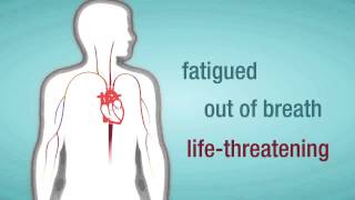 Valve Regurgitation When a Heart Valve Leaks [upl. by Conrado]