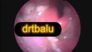 Acute epiglotititis [upl. by Gareri]