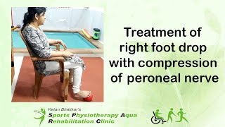 Treatment of right foot drop with compression of peroneal nerve [upl. by Anica300]