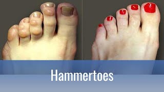 Hammertoes Why do they hurt and how to fix them [upl. by Adiazteb]