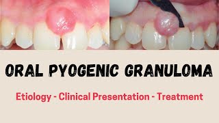 ORAL PYOGENIC GRANULOMA Etiology  Clinical Presentation  Treatment [upl. by Lletnahc]