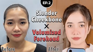 SUB Quick Cheekbone Reduction amp Full Face Fat Grafting Surgery in Korea  Zygoma Reduction RESULTS [upl. by Yesnel]