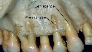 Fenestration amp Dehiscence [upl. by Anauqaj210]