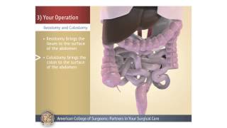 ColostomyIleostomy Your Operation [upl. by Drannel810]