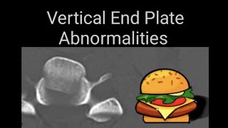 Vertibral end plates abnormalities on lumbosacral spine x rays and CT images [upl. by Sander802]