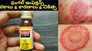 Allergies and skin infections with sapat lotion in allopathic in Telugu l ringworms l thamara l icch [upl. by Lavinia]