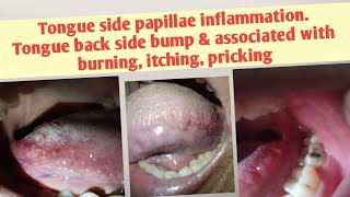 Tongue side papillae inflammationTongue back side bump amp associated with burning itching pricking [upl. by Anwaf]