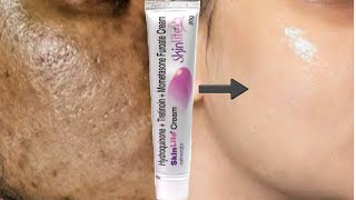 SkinLite Cream  remove pigmentation dark spots Acne marks pimple marks [upl. by Sauveur]