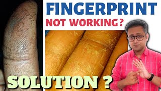 Protect your fingerprints  Dryness of hands  Keratolysis exfoliativa  Hindi [upl. by Neelra883]