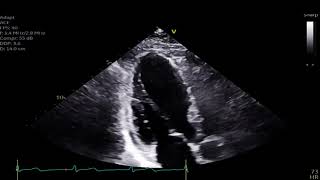 Mid Wall Stress Cardiomyopathy [upl. by Tolmann]