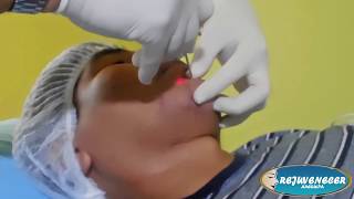 Eliminación de cicatrices con el Láser Fotona 4D  Dr Gustavo Ponce Clínica Rejuvenecer Arequipa [upl. by Spark]