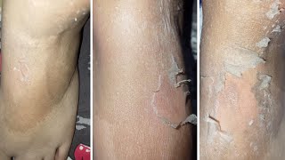 Body Chemical Peel At Home [upl. by Belayneh175]