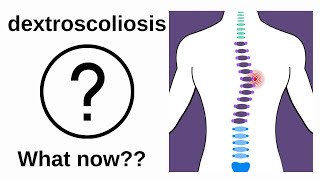 What is dextroscoliosis [upl. by Natanoy]