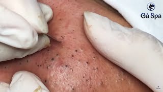 Dr Lee Removes Spongy Brainlike Bump on Patients Head  Dr Pimple Popper [upl. by Retloc]