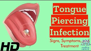 Tongue Piercing Gone Wrong Recognize Infection Signs and Solutions [upl. by Htor]