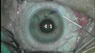 Refractive Surgery LASIK [upl. by Nynnahs]