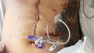 Intro to me Getting a TG Total Gastrectomy and removal of esophagus Life after [upl. by Boote679]