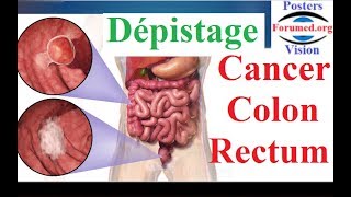 Cancer du colon rectum Dépistage et Facteurs de Risque [upl. by Demott]