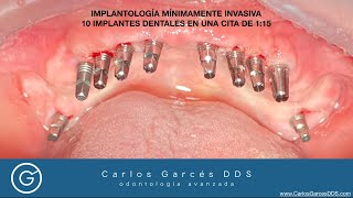 Implantes Dentales de Carga Inmediata Bogota con Cirugía Mínimamente Invasiva sin hueso odontólogo [upl. by Rosenzweig968]