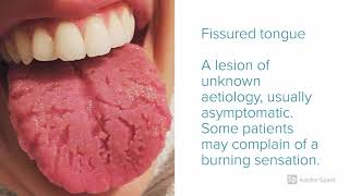 Oral Pathology  5 Tongue Leisons You Must know [upl. by Sivie]