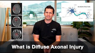 What is Diffuse axonal injury [upl. by Feingold]