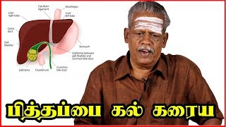 பித்தப்பை கல் கரைய இயற்கை மருத்துவம்  Gallstones Symptoms Causes Natural Treatment in Tamil [upl. by Eemia]