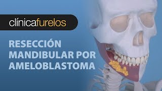 Resección mandibular por ameloblastoma 02 [upl. by Ahidam14]