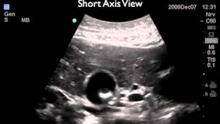 How To Gallbladder Ultrasound Part 2  Gallstones Case Study Video [upl. by Imoyaba935]