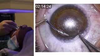 London Vision Clinic  ReLEx SMILE  Live laser eye surgery  Professor Dan Reinstein [upl. by Aifos]