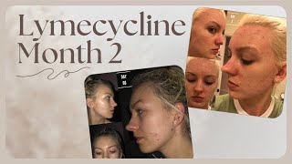 ACNE MONTH 2 ON LYMECYCLINE [upl. by Wren736]