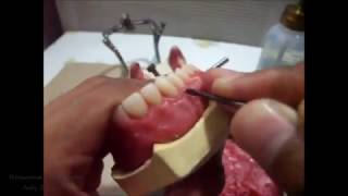 Festooning a Complete denture [upl. by Aihtak]