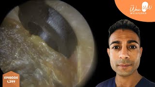 1299  Ear Hook amp Jobson Horne Ear Wax Removal [upl. by Naoma]