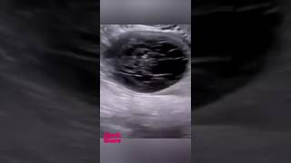 Ovarian hemorrhagic cyst Ultrasoundfypviraltrendingshortsforyouultrasoundsubscribe [upl. by Nolla]