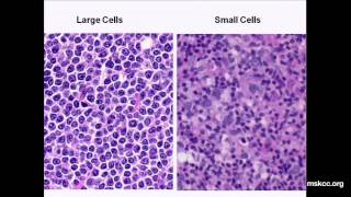 What You Need to Know about NonHodgkins Lymphoma Presentation [upl. by Oer]