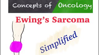 Ewing’s Sarcoma How is it different from other Sarcomas [upl. by Thamos]