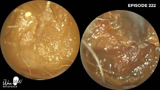 222  Very Blocked Ear Wax Removal using the WAXscope®️ [upl. by Anivel]