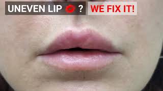 CORRECTING UNEVEN LIP FILLER USING HYALURONIDASE [upl. by Daenis186]