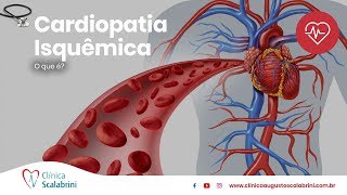 Cardiopatia IsquÃªmica  Por Prof Augusto Scalabrini Neto [upl. by Halette]