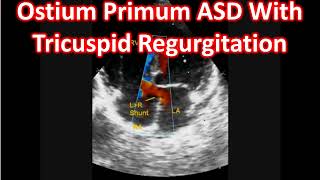 Ostium Primum ASD With Tricuspid Regurgitation [upl. by Aisan]