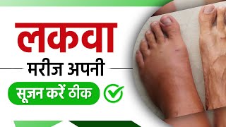 लकवा मरीज अपना सूजन करे ठीक  Swelling Treatment for Paralysis Patient  Paralysis  Stroke  Sriaas [upl. by Rosdniw]