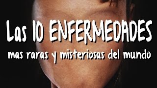 Las 10 ENFERMEDADES MAS MISTERIOSAS y raras del mundo [upl. by Nylarej]