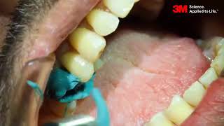 TripleTray technique for posterior Impressions using 3M Monophase [upl. by Bruning]