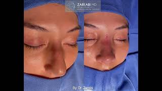 Closed Piezo Ultrasonic Rhinoplasty [upl. by Lokin179]