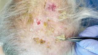 Debulking Lesions on the Scalp Erosive Pustulosis of the Scalp  CONTOUR DERMATOLOGY [upl. by Yahsal]