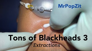 Tons of Blackheads part 3 Acne extractions Many comedones removed Patient improving MrPopZit [upl. by Kurzawa525]