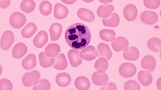 Complete Blood Count  CBC Interpretation Leukocytosis [upl. by Ensoll]